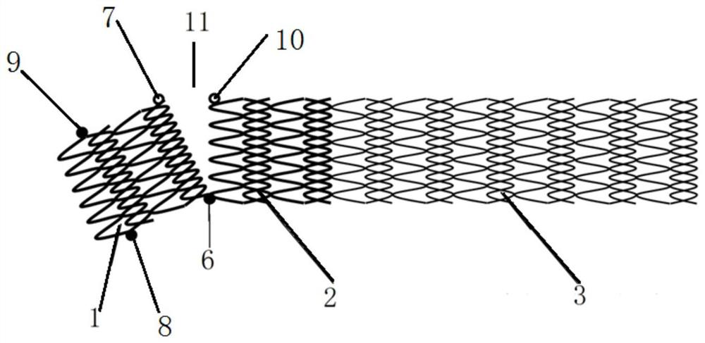 Split iliac vein stent and placement method thereof