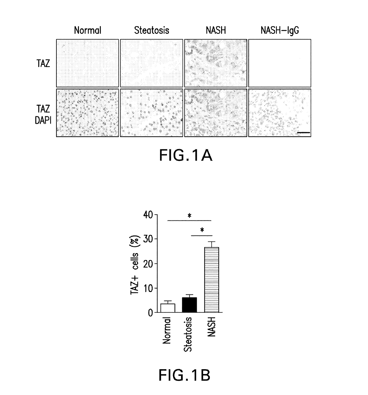 Therapeutic targets involved in the progression of nonalcoholic steatohepatitis (NASH)