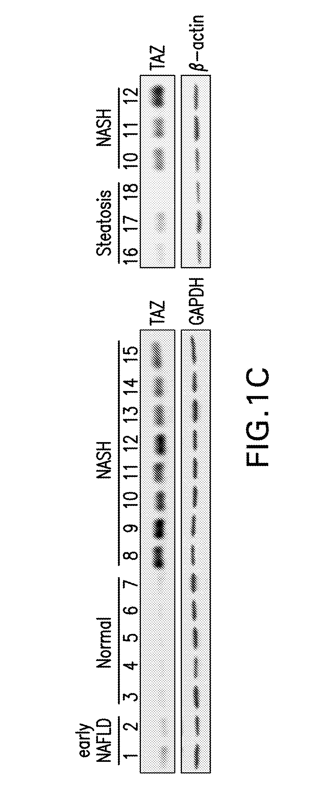 Therapeutic targets involved in the progression of nonalcoholic steatohepatitis (NASH)