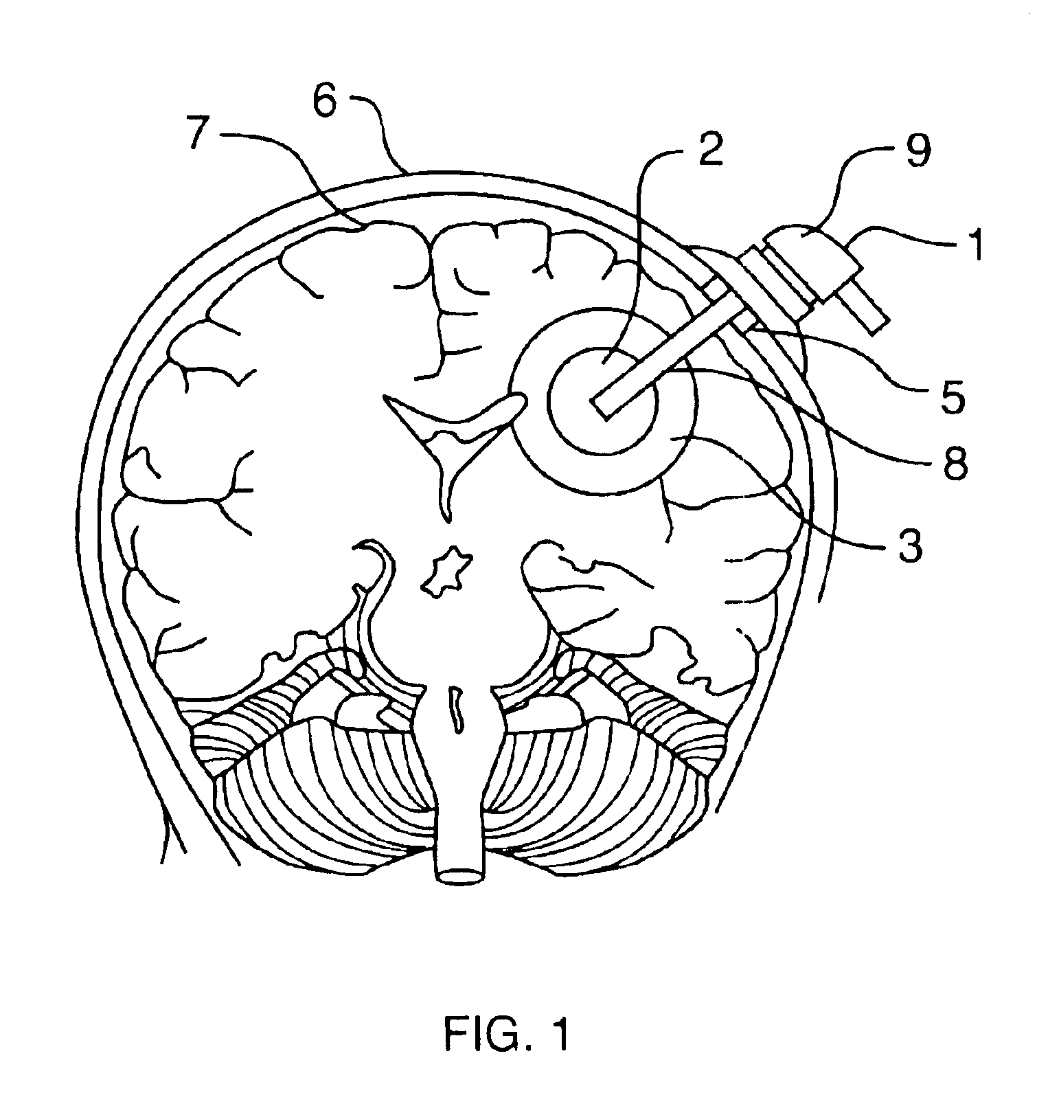 Method and device for reducing death and morbidity from stroke
