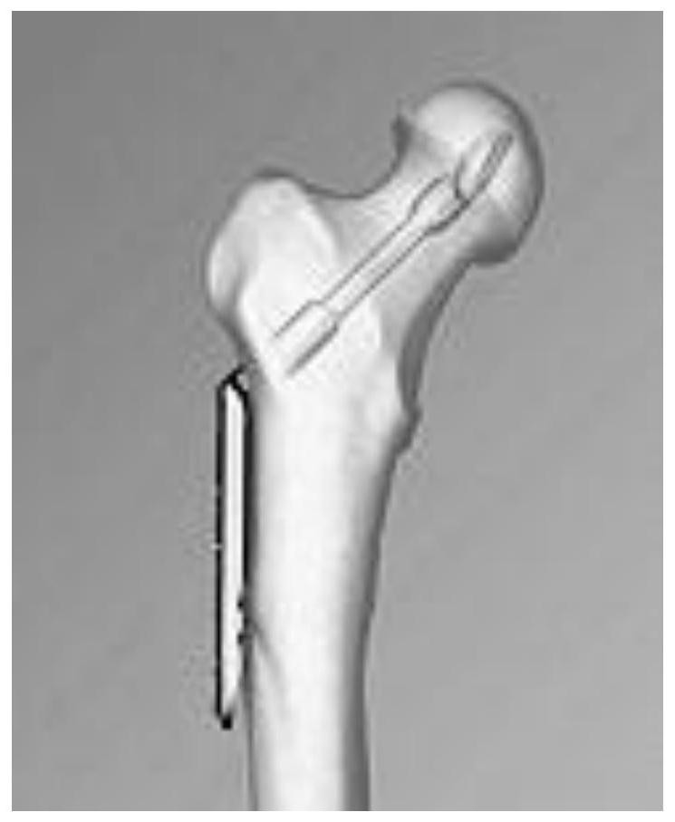 A femoral neck fracture fixation device