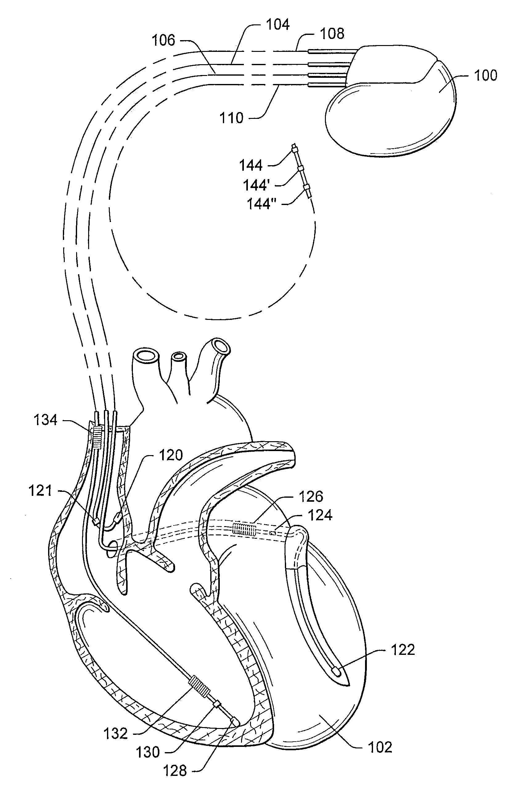 Systems and methods for determining inter-atrial conduction delays using multi-pole left ventricular pacing/sensing leads