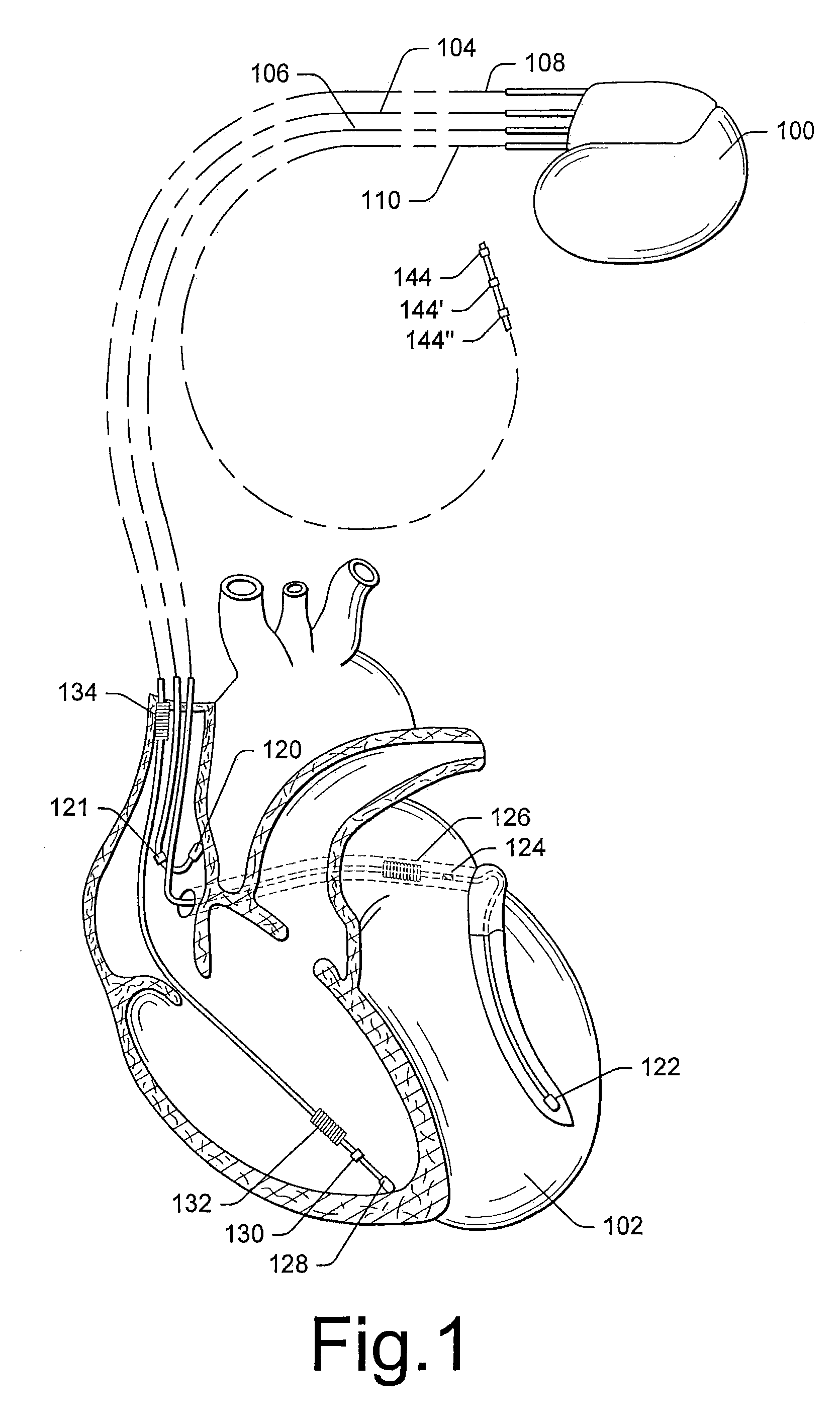 Systems and methods for determining inter-atrial conduction delays using multi-pole left ventricular pacing/sensing leads