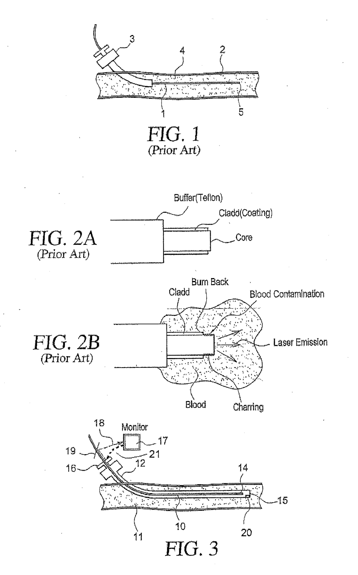 Endovascular Method and Apparatus with Electrical Feedback