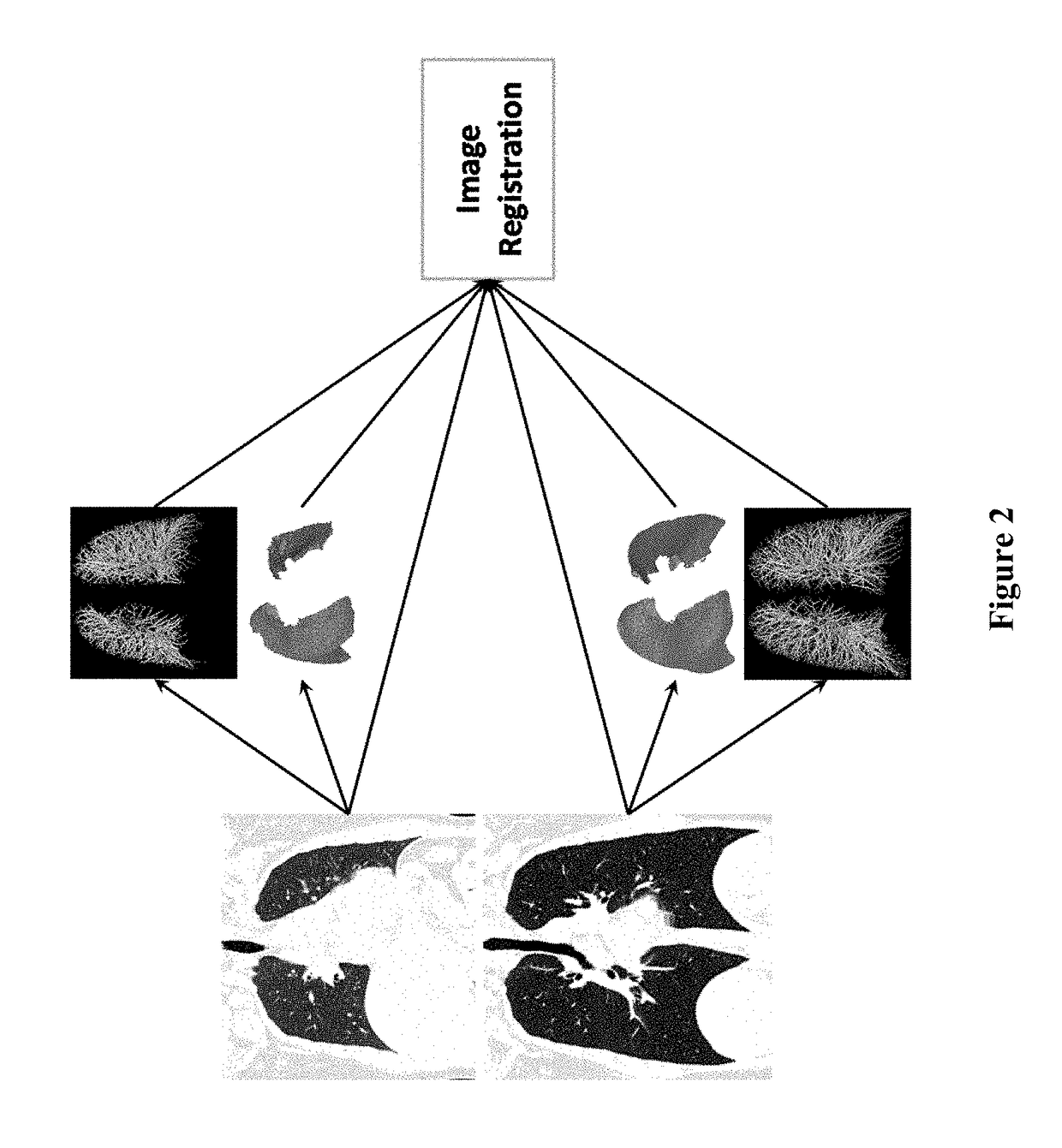 Visualization and quantification of lung disease utilizing image registration