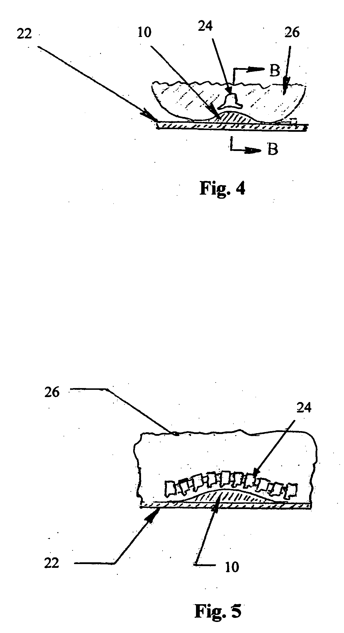 Emergency transport back support apparatus and method