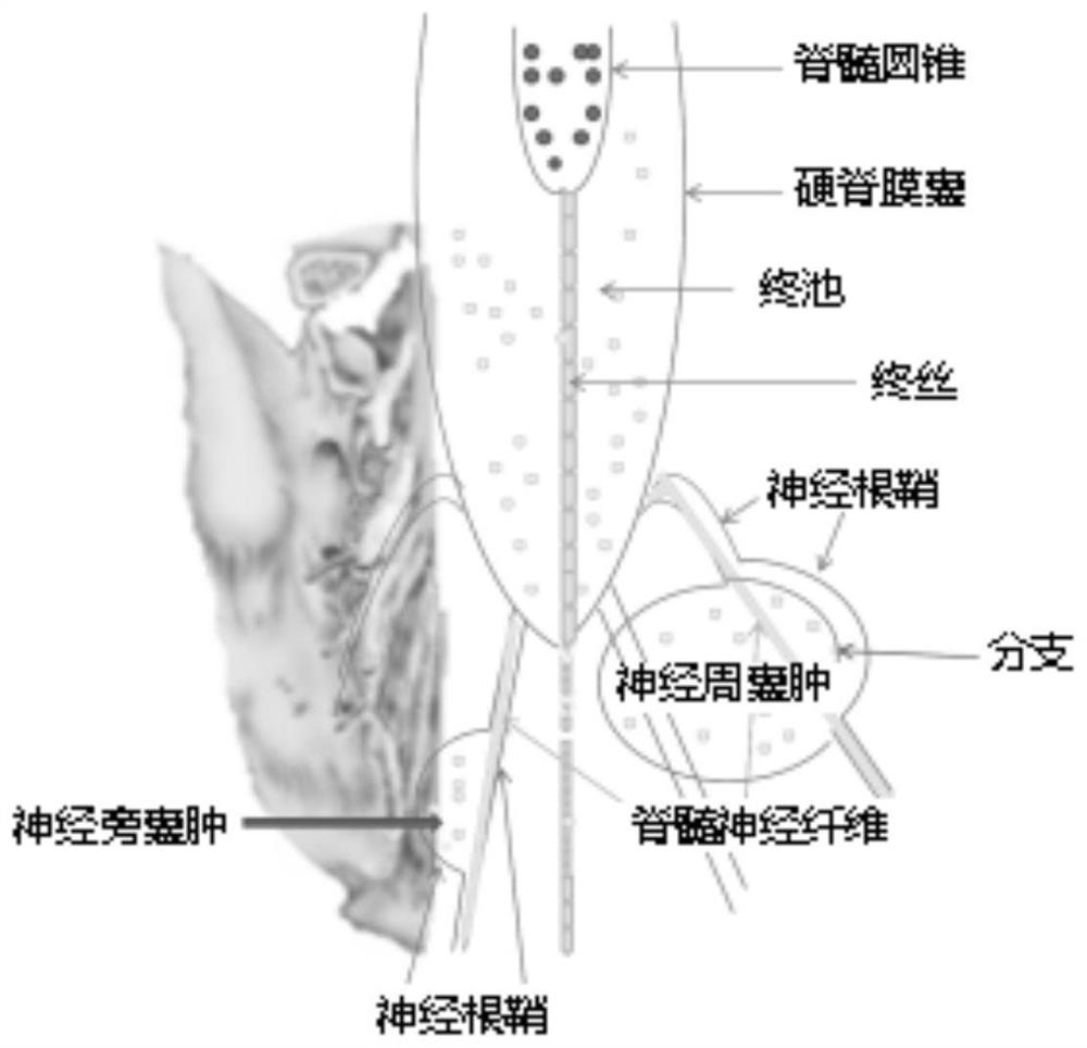 Method for establishing spinal dura mater leakage arachnoid hernia type sacral canal cyst model