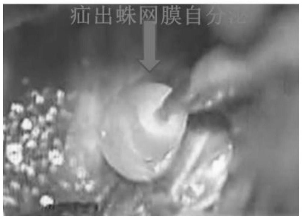 Method for establishing spinal dura mater leakage arachnoid hernia type sacral canal cyst model