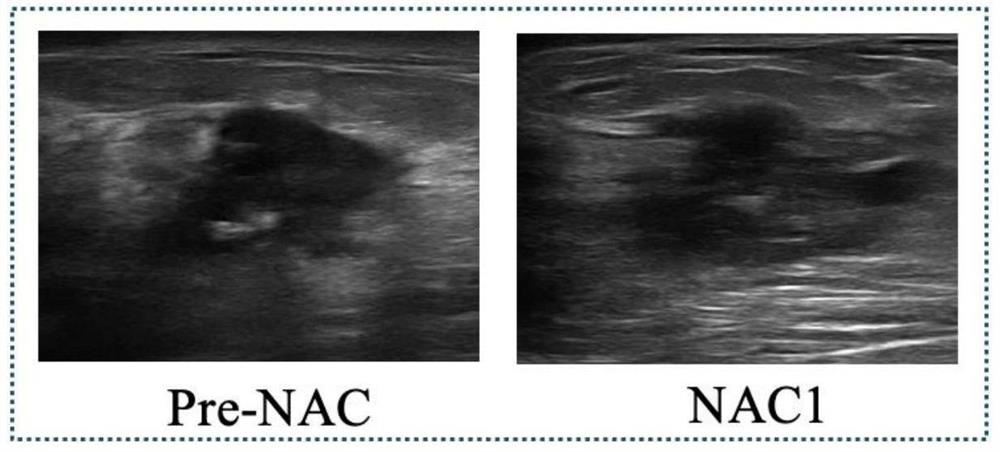 Early prediction method for curative effect of cancer chemotherapy based on two-channel convolutional neural network