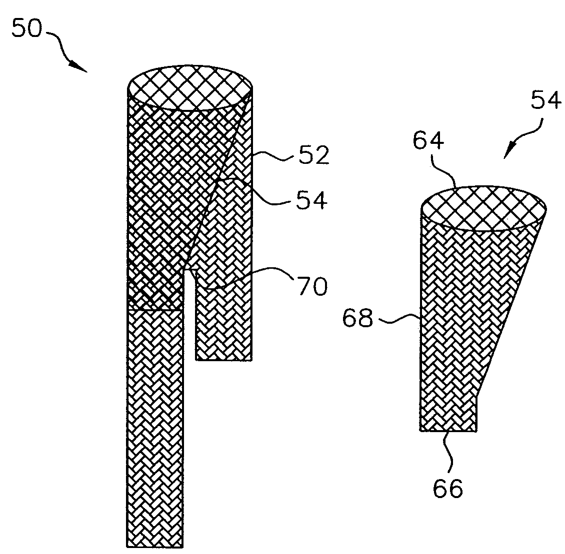 One-branch stent-graft for bifurcated lumens