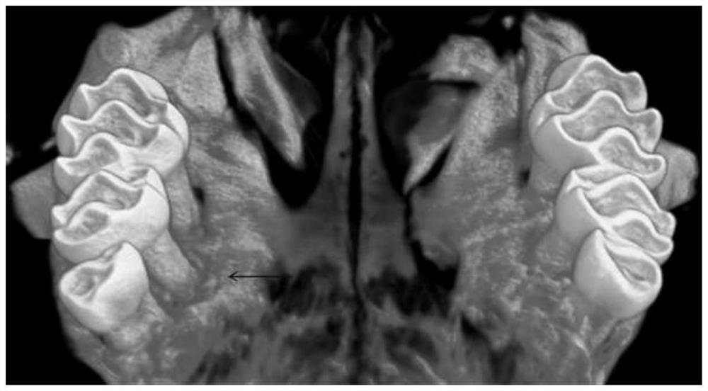 Modeling method for mouse with complex periodontitis and tooth movement