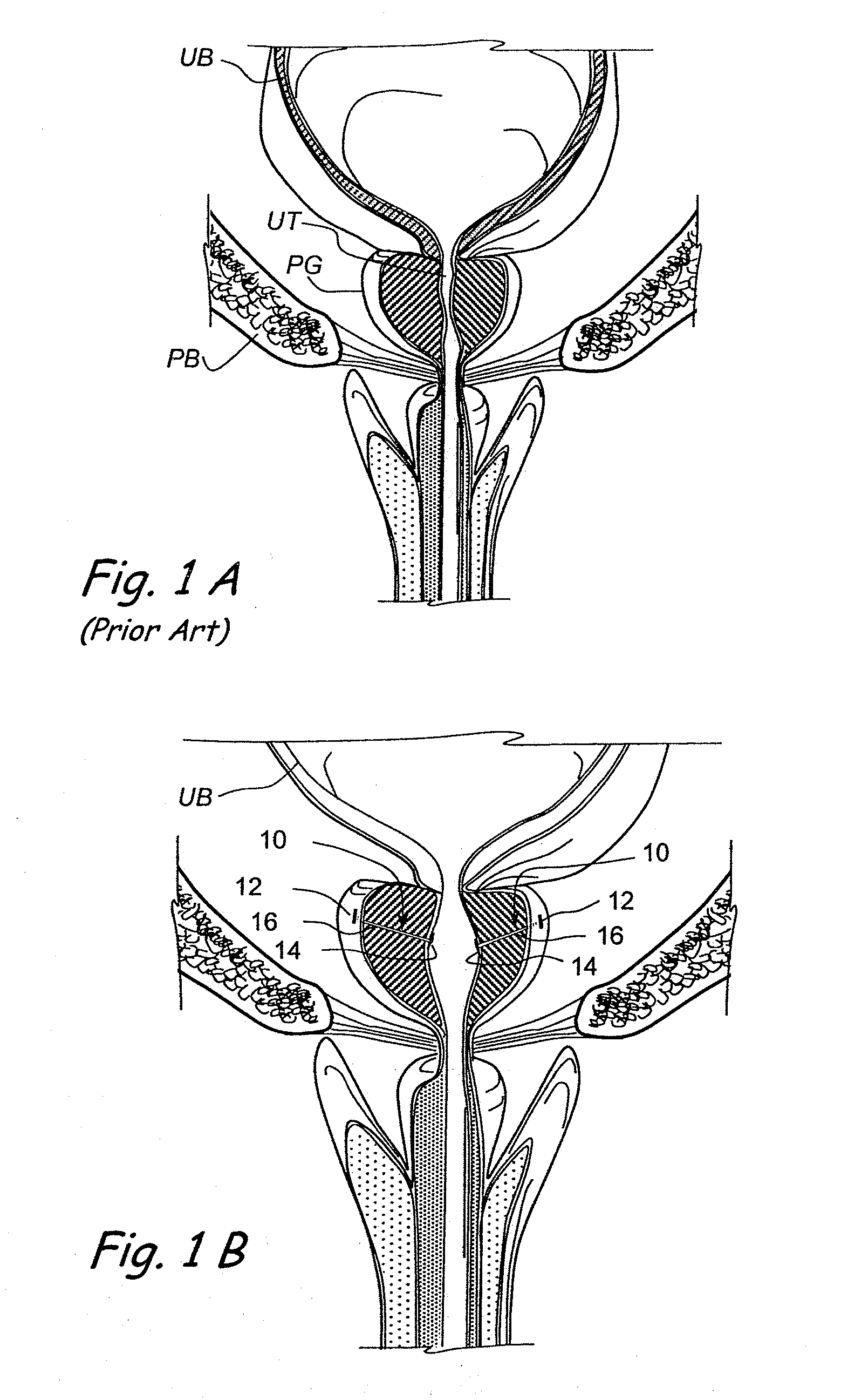 Devices, systems and methods for retracting, lifting, compressing, supporting or repositioning tissues or anatomical structures