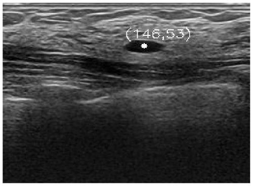 End-to-end mammary gland ultrasound image segmentation method based on Distance-AttU-Net (Distance-AttU-Net)