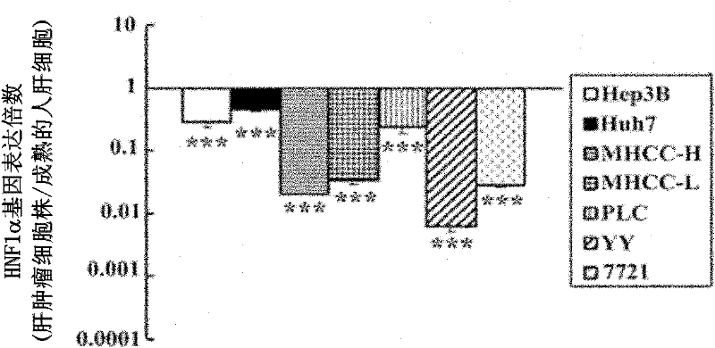 Method for treating human malignant solid tumor by using hepatocyte nuclear factor-1alpha