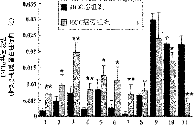 Method for treating human malignant solid tumor by using hepatocyte nuclear factor-1alpha