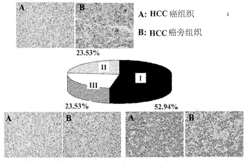 Method for treating human malignant solid tumor by using hepatocyte nuclear factor-1alpha