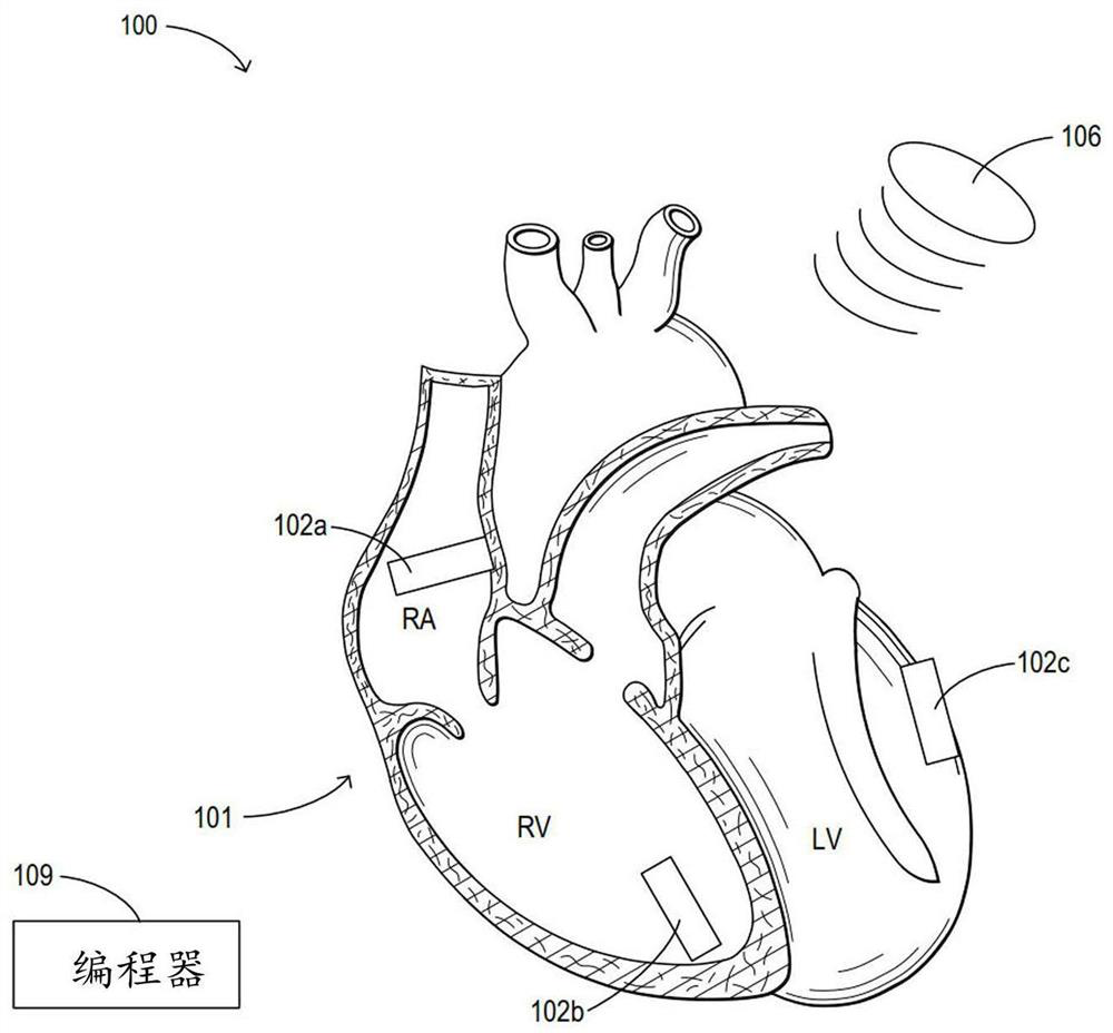 Systems and method for performing cardiac resynchronization therapy (crt) using leadless pacemakers