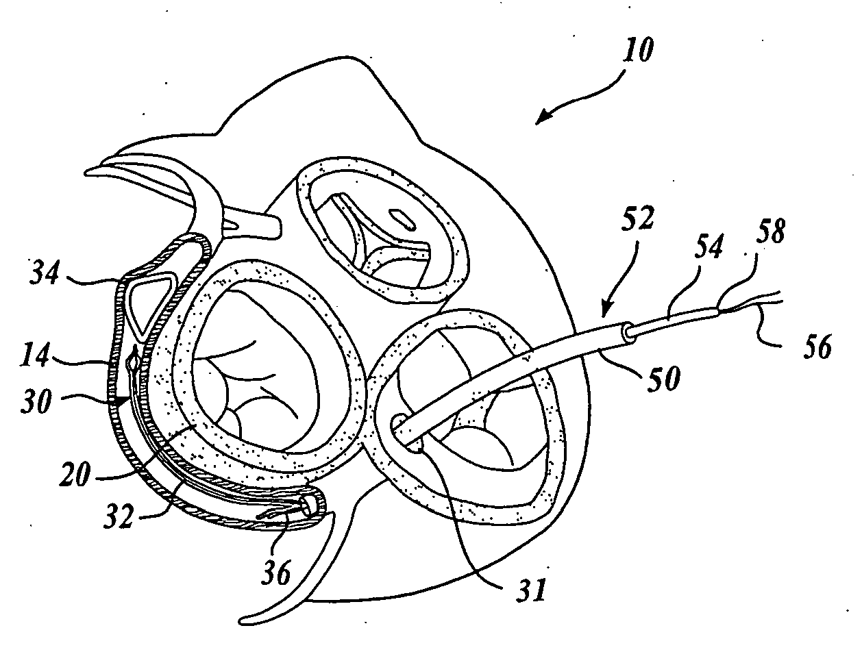 Body lumen device anchor, device and assembly