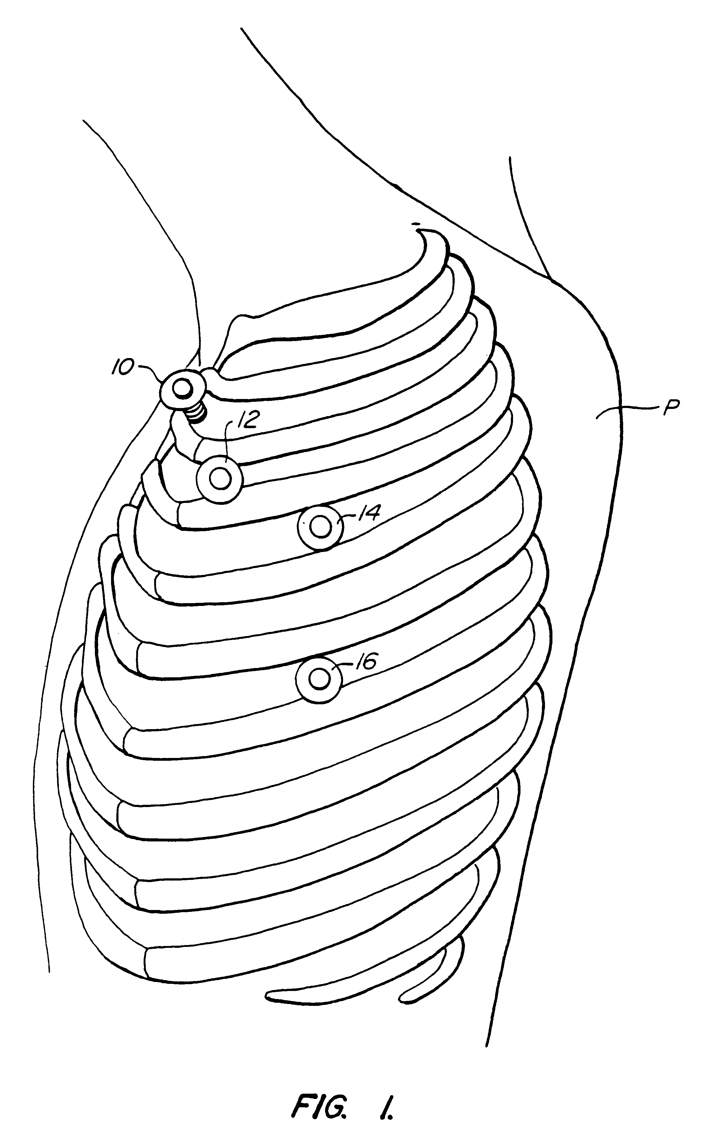 Method and systems for performing thoracoscopic cardiac bypass and other procedures