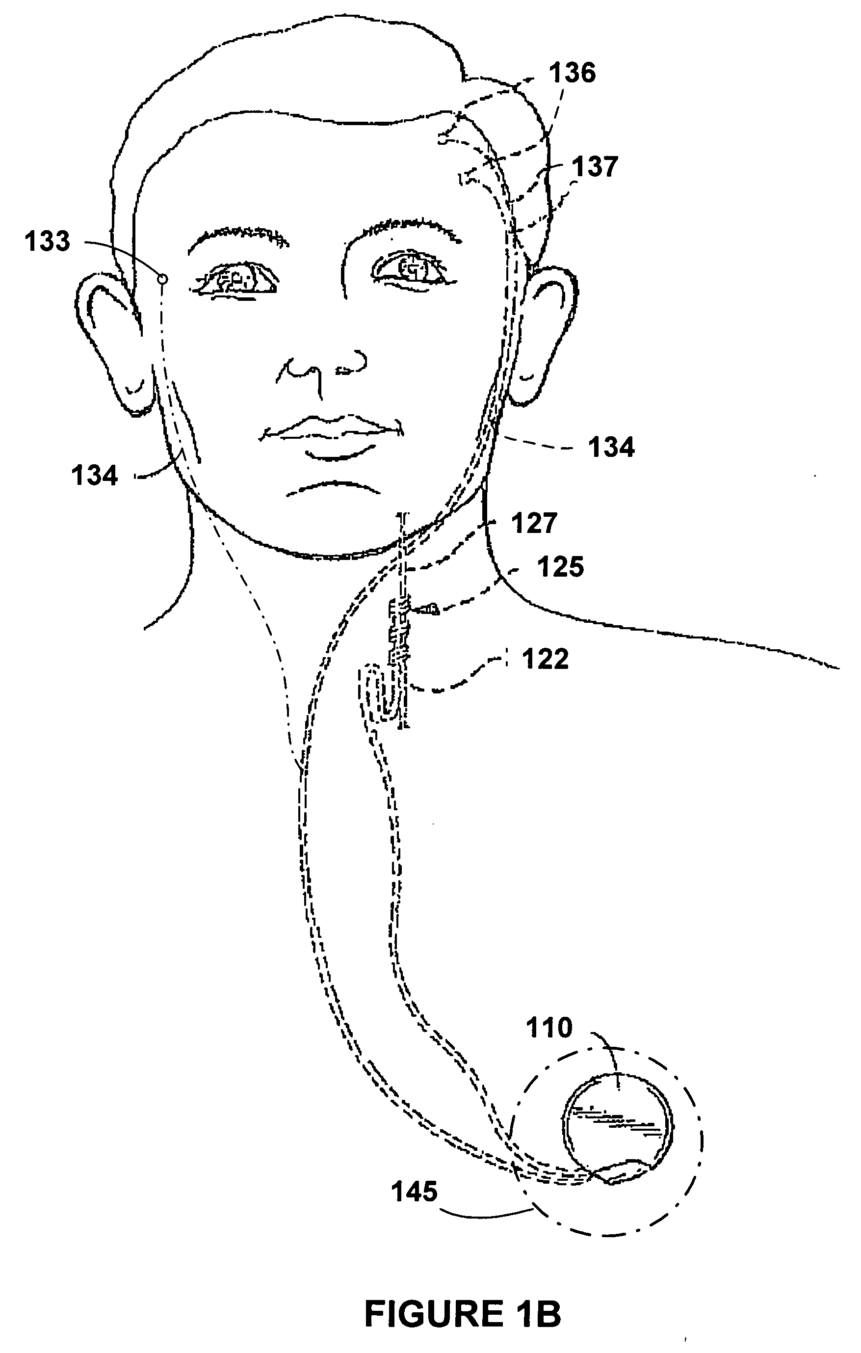 Variable output ramping for an implantable medical device