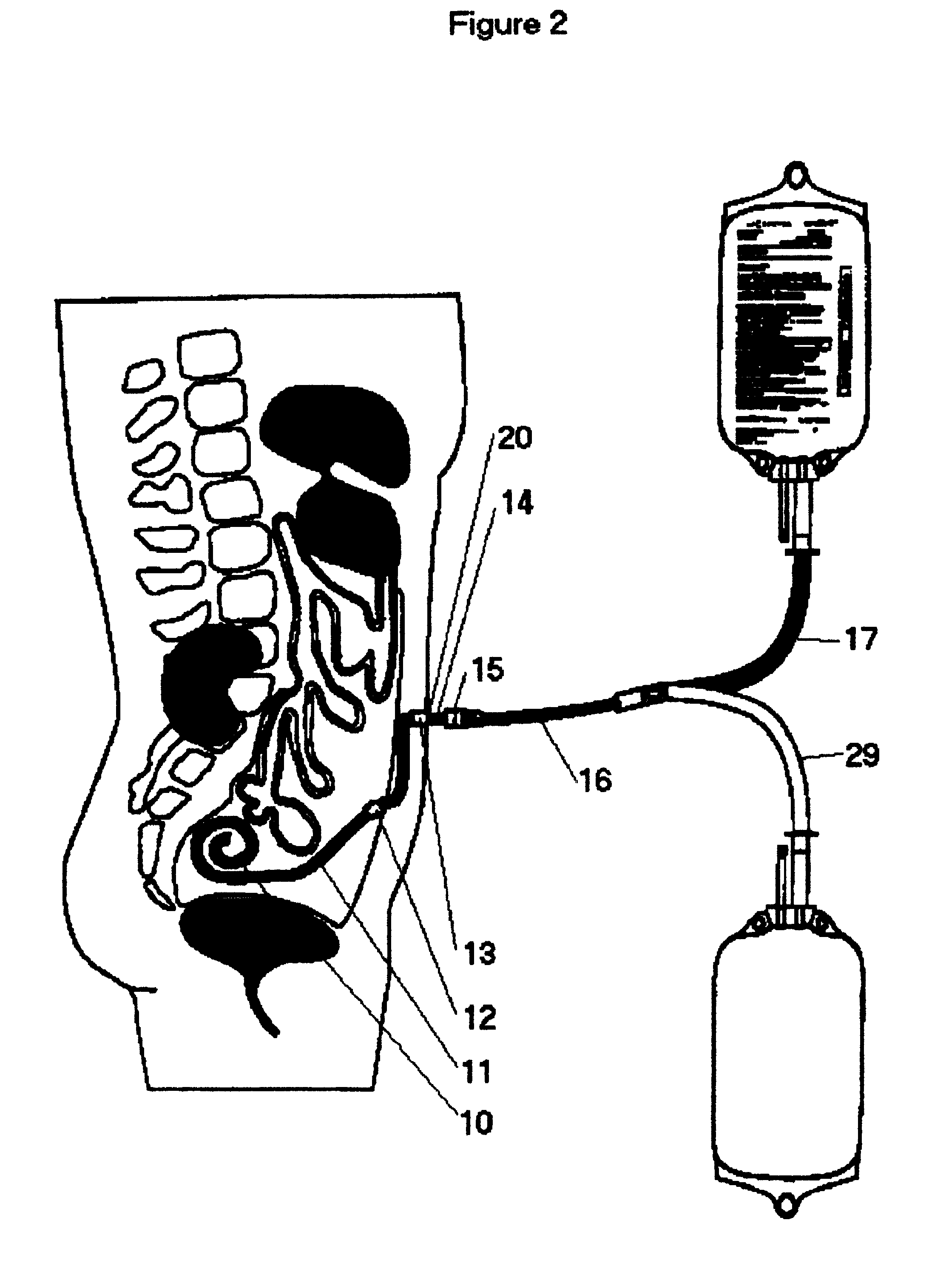 Garment for securing and exposing a peritoneal dialysis catheter and catheter exit site