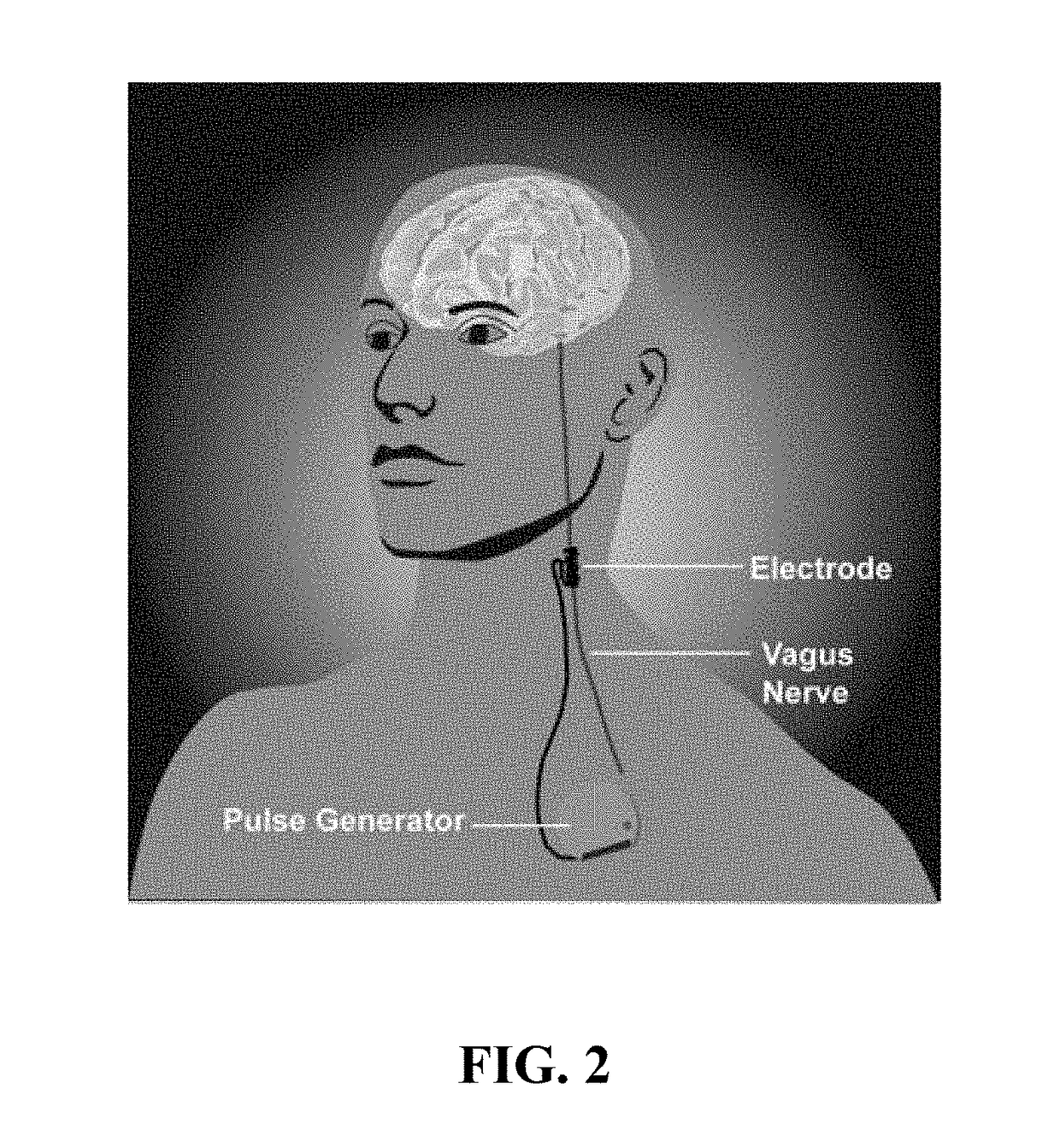 Skull implanted electrode assembly for brain stimulation