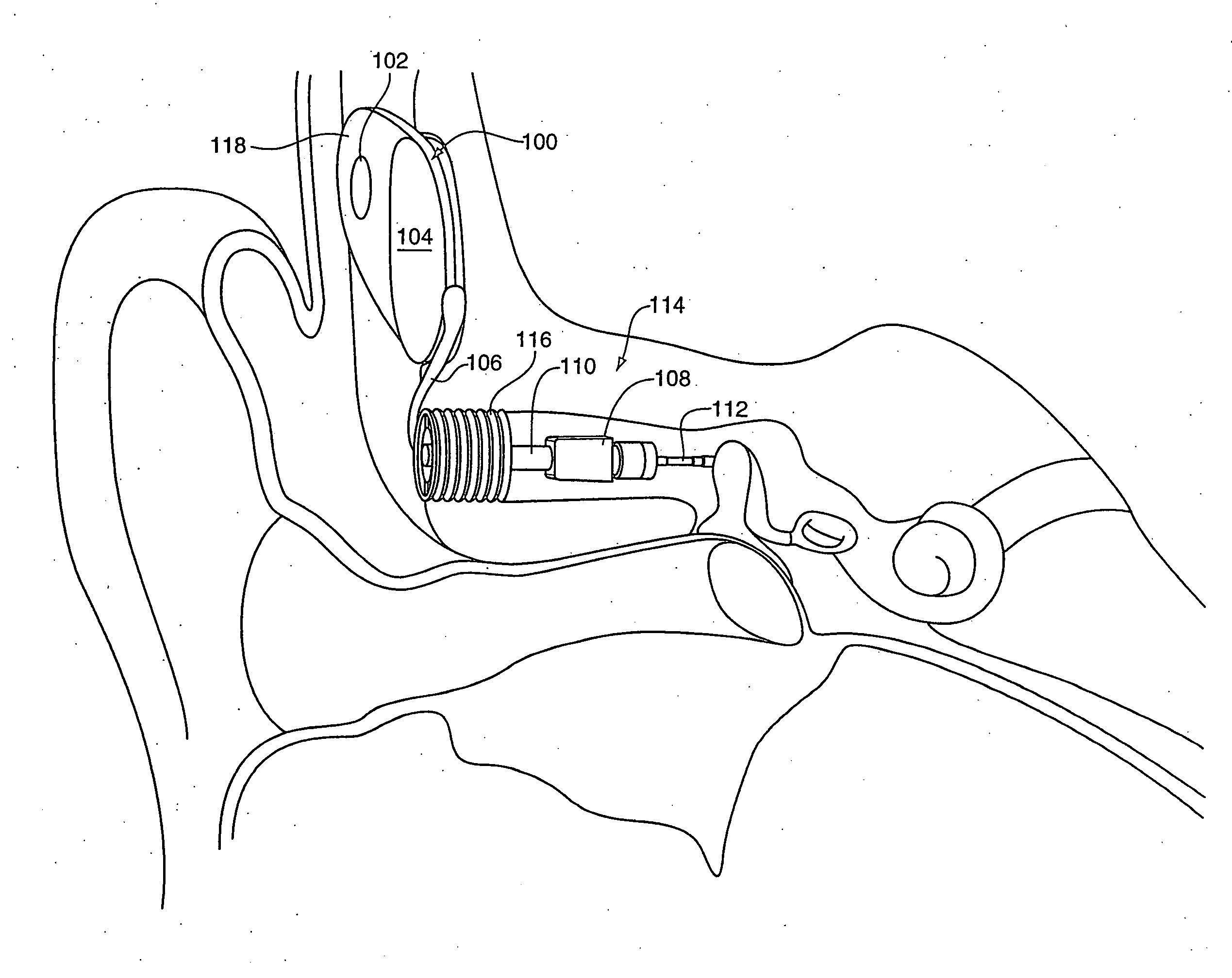 Method and system for external assessment of hearing aids that include implanted actuators
