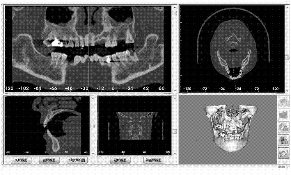 Manufacturing method of tooth implantation operation guide plate based on body image processing