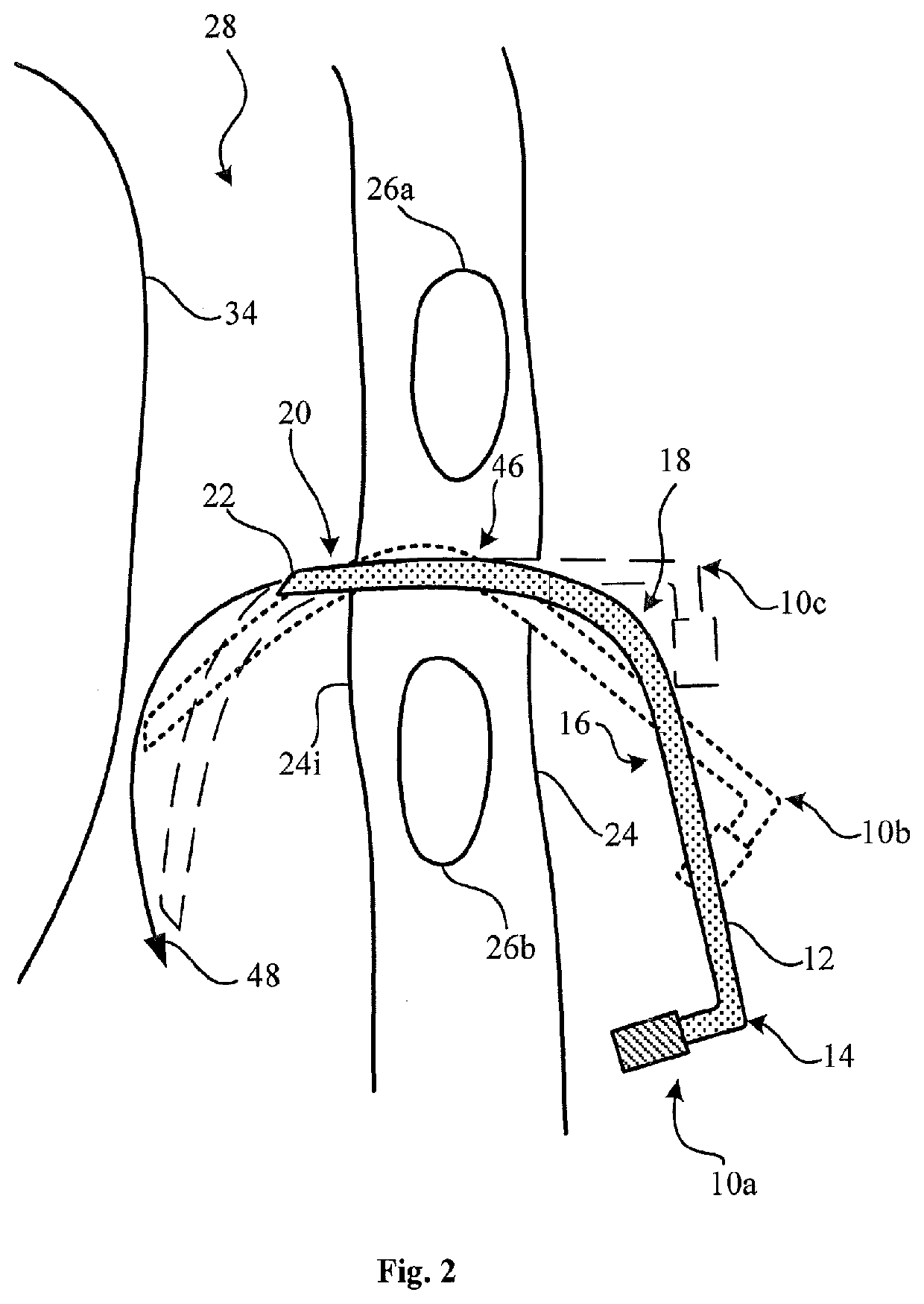 Needle assembly for relieving a pneumothorax