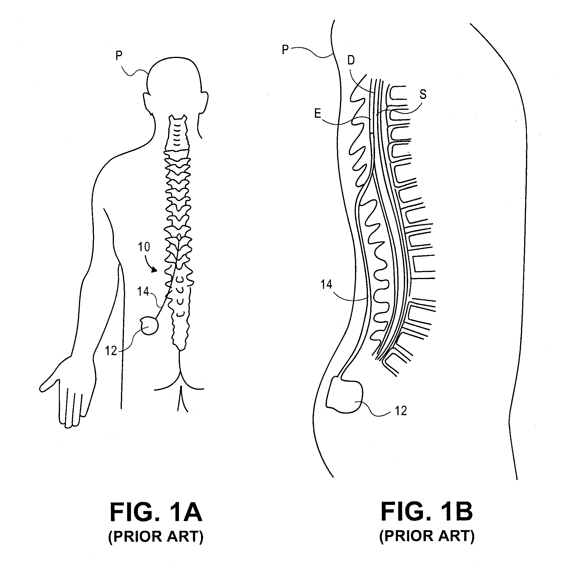 Expandable stimulation leads and methods of use