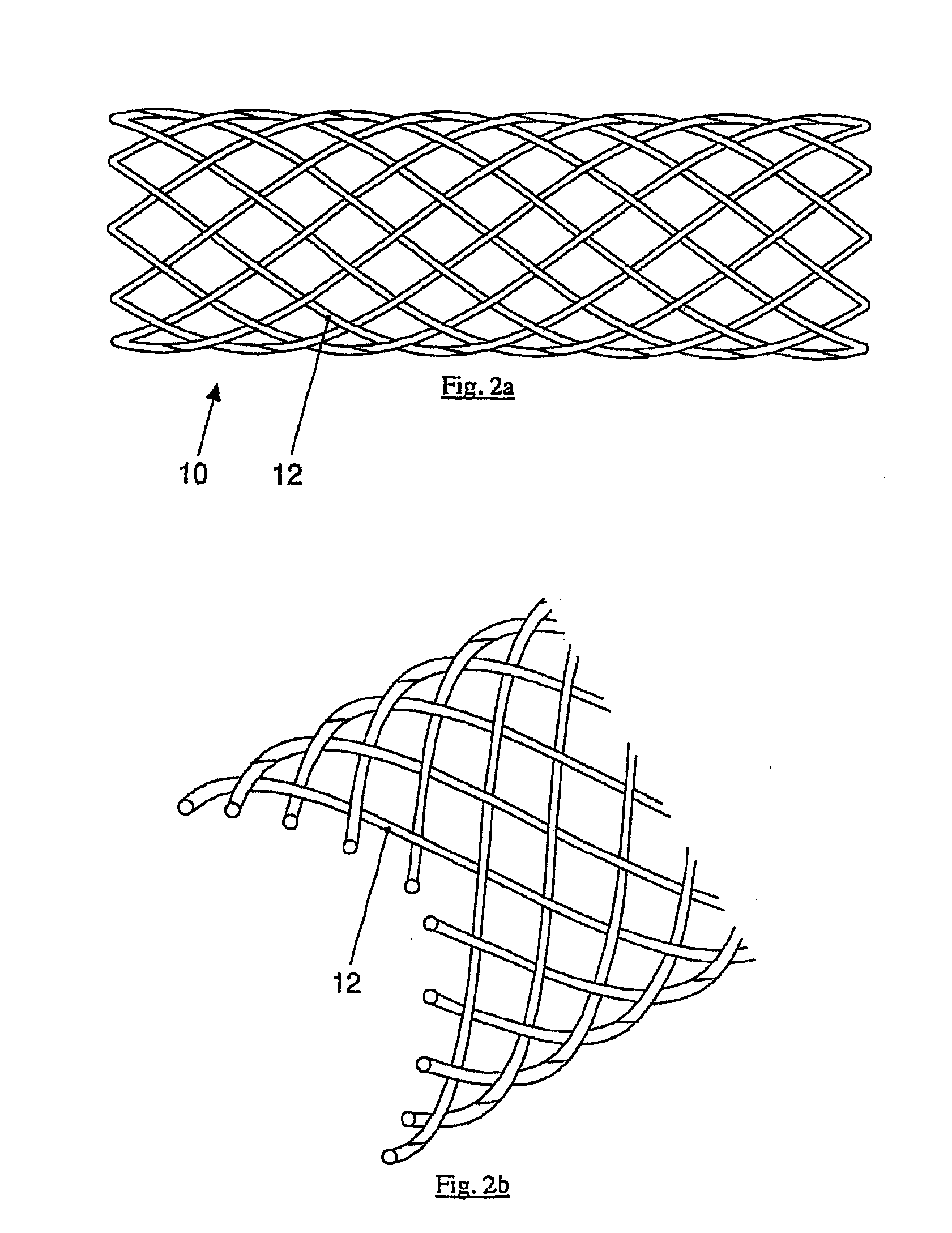 Absorbable Medical Implant Made of Fiber-Reinforced Magnesium or Fiber-Reinforced Magnesium Alloys