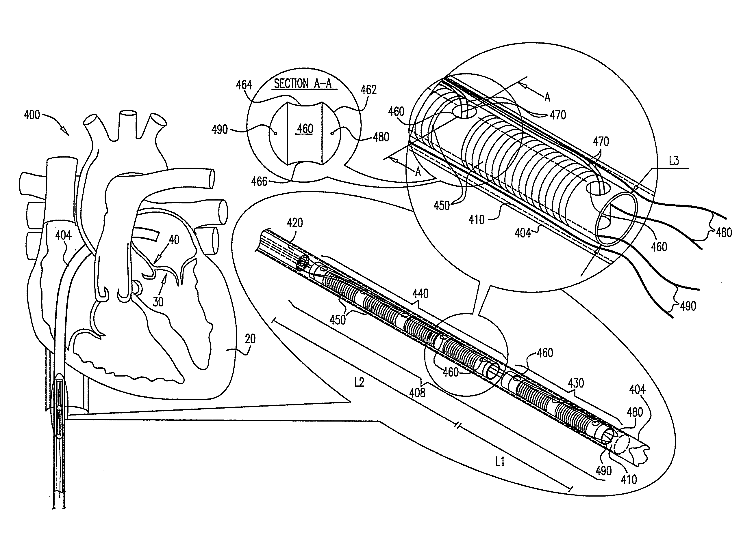 Segmented ring placement