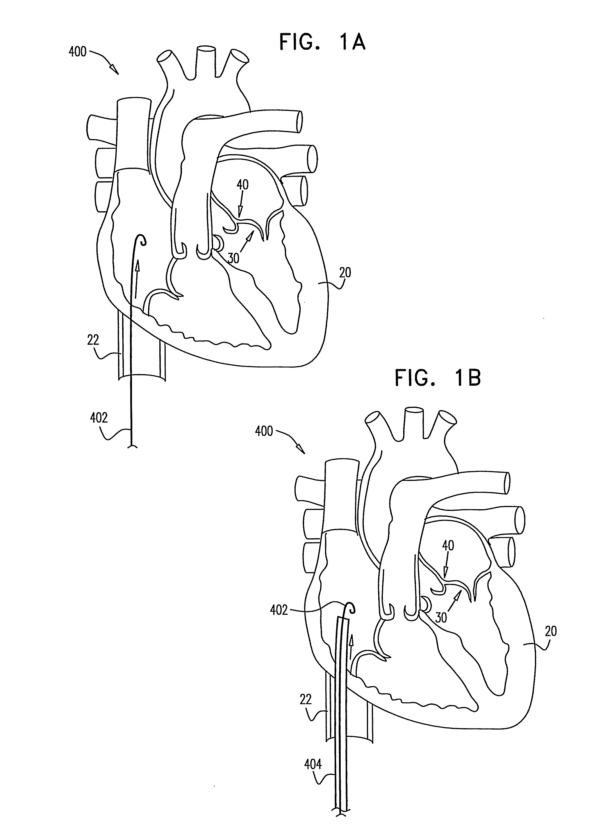 Segmented ring placement