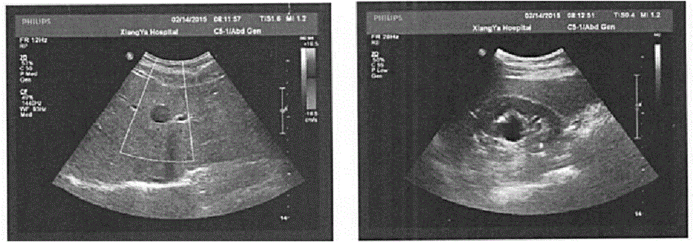 Medicine for treating fatty liver, prostatitis, diabetes, nephralgia and kidney deficiency