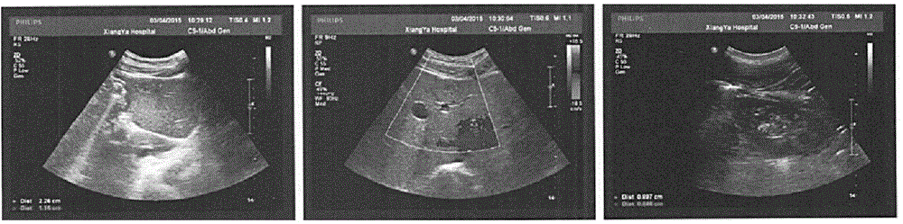 Medicine for treating fatty liver, prostatitis, diabetes, nephralgia and kidney deficiency