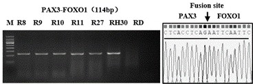 Molecular marker of rhabdomyosarcoma fusion gene related circular RNA and application of molecular marker