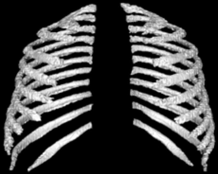 A rib visualization aided diagnosis method for rib fractures