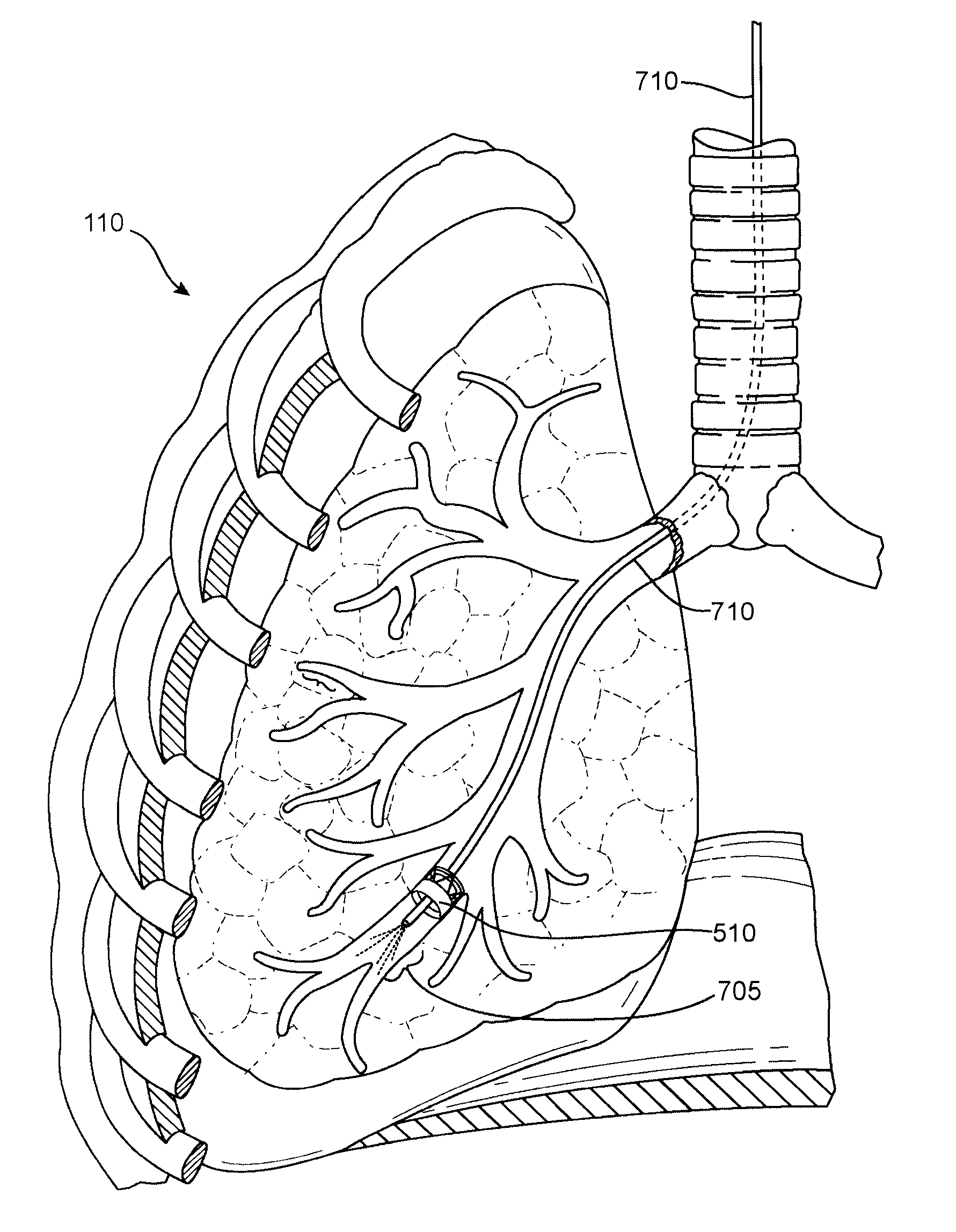 Methods and Devices for Lung Treatment