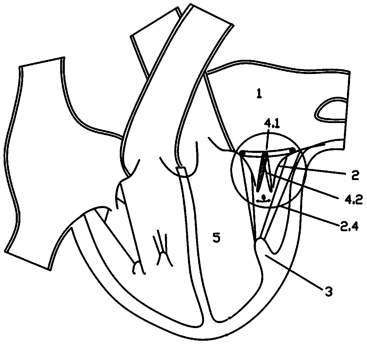 Self-adaptive locating mitral valve closing plate blocking body for repairing mitral regurgitation