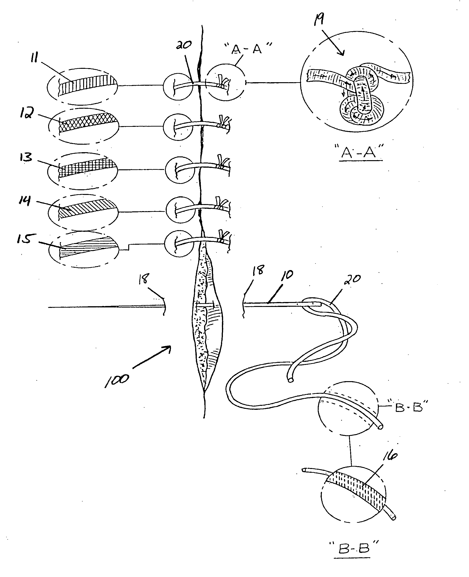 Suture treatment method and suture construction/kit therrefor
