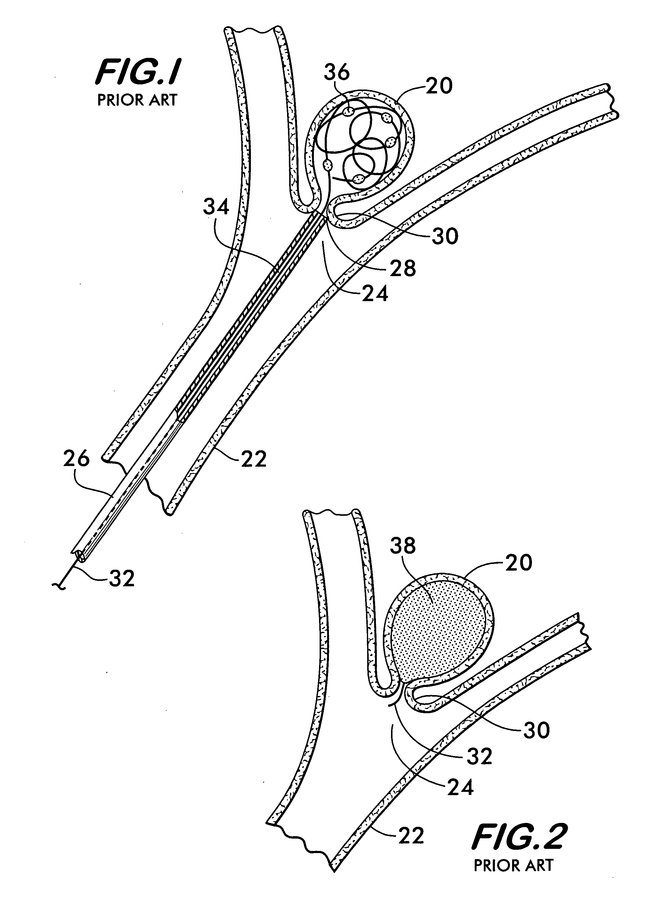 Three-dimensional coils for treatment of vascular aneurysms