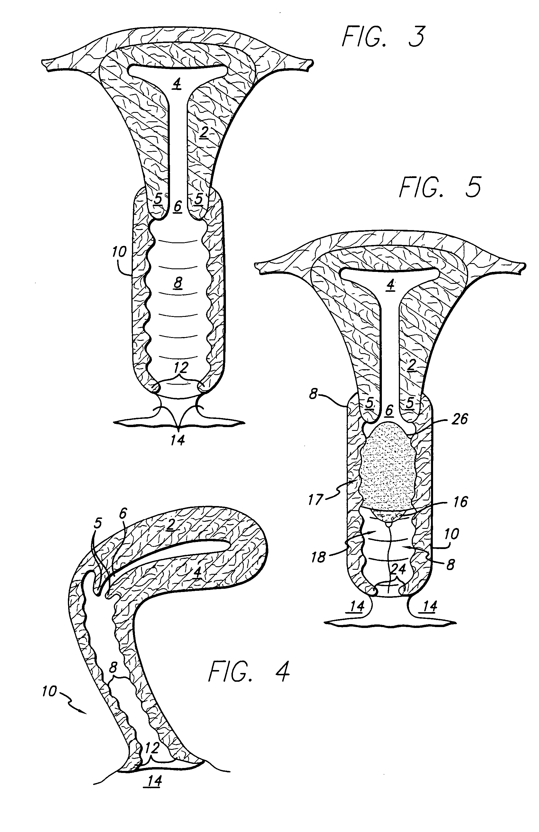 Coated vaginal device for delivery of anti-migraine and anti-nausea drugs and a method for treatment of migraine and nausea