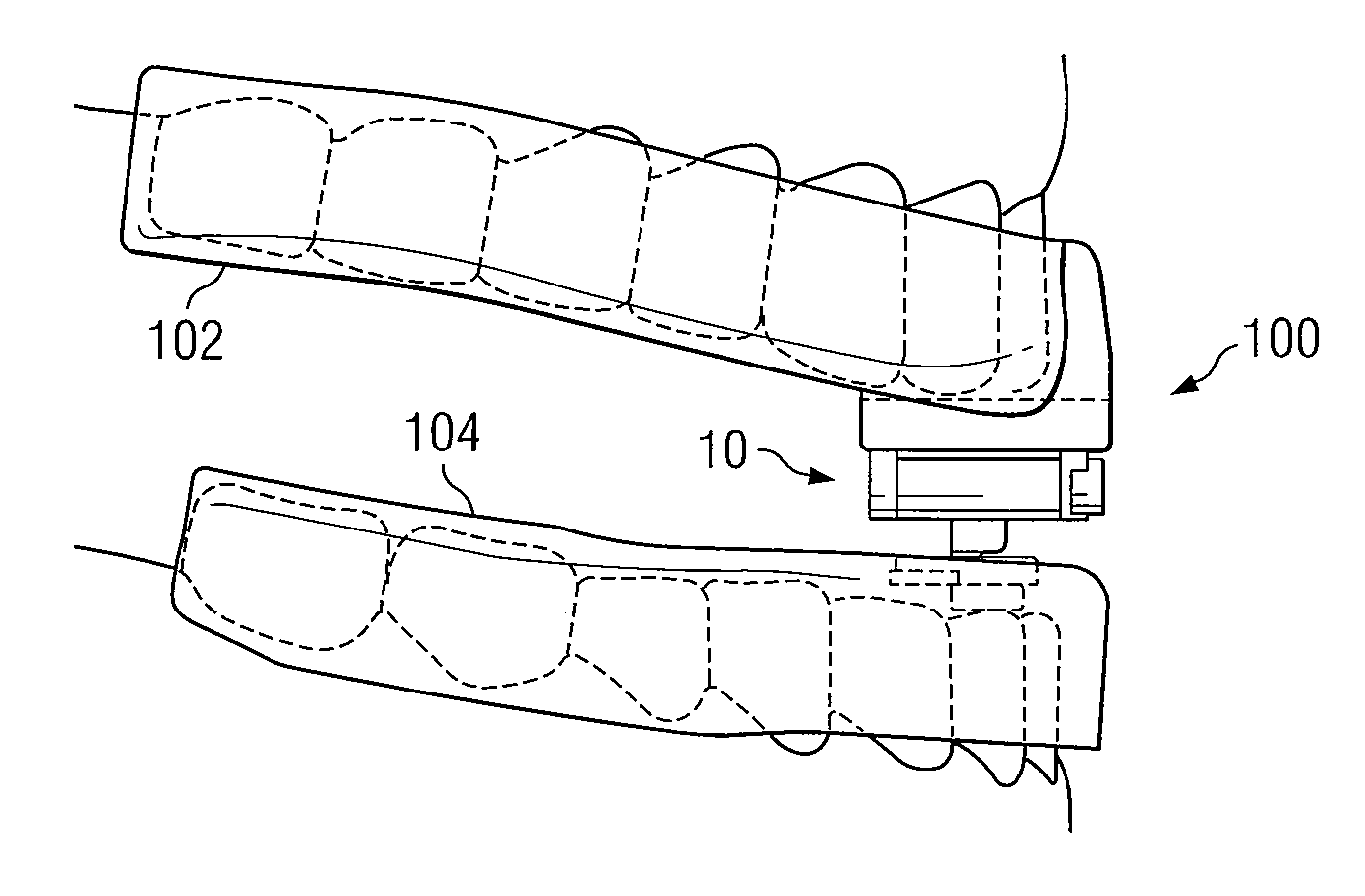 Oral Appliance for Treating a Breathing Condition