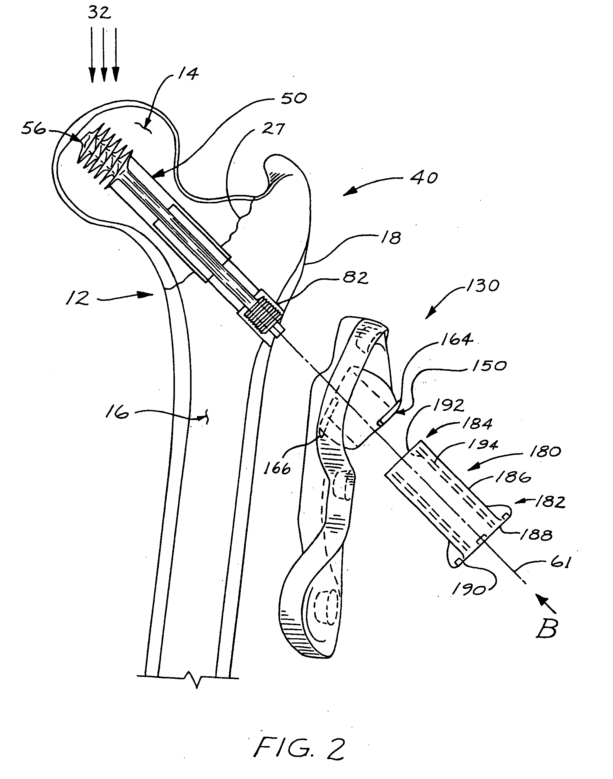 Compression bone screw device