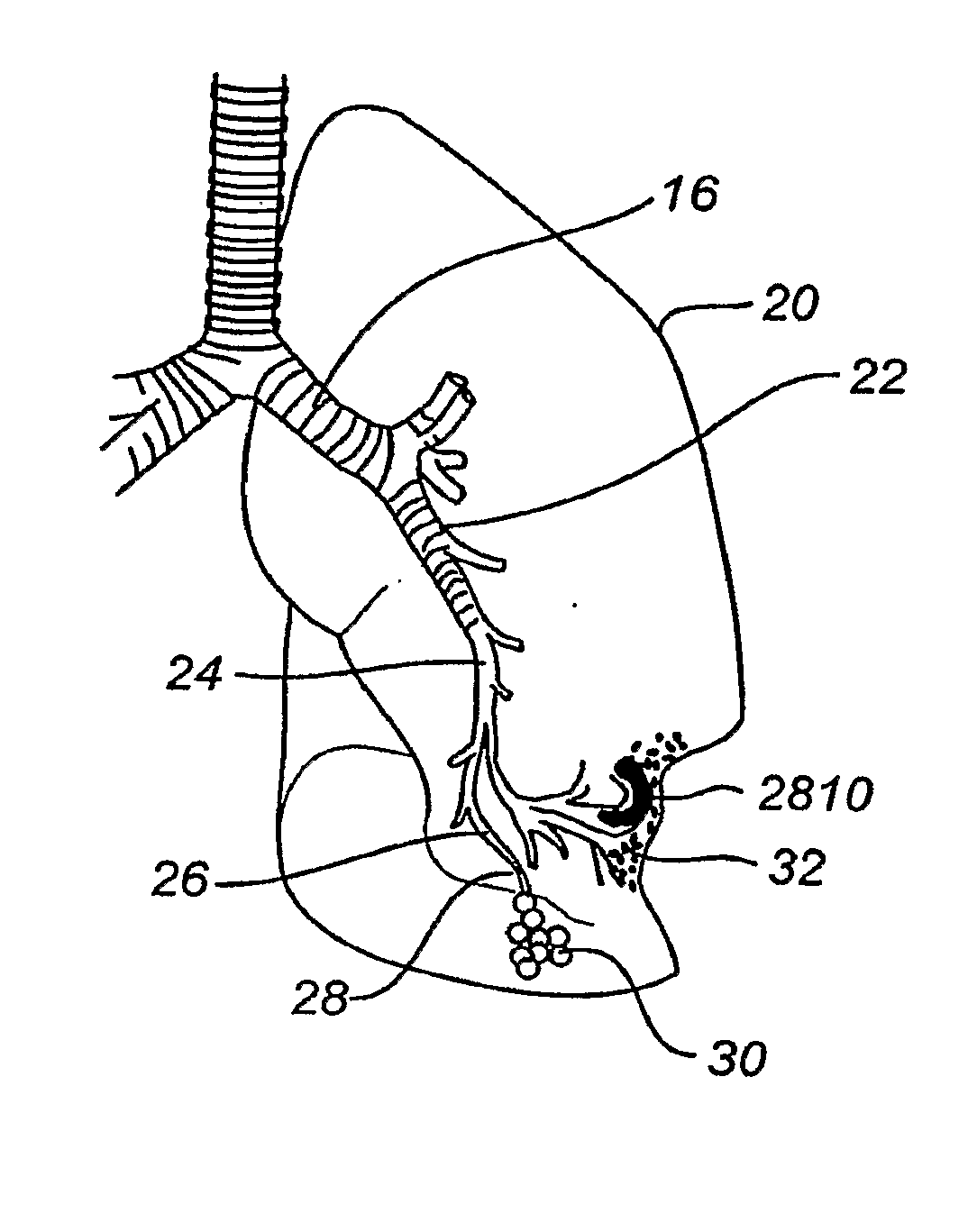 Minimally invasive lung volume reduction devices, methods, and systems