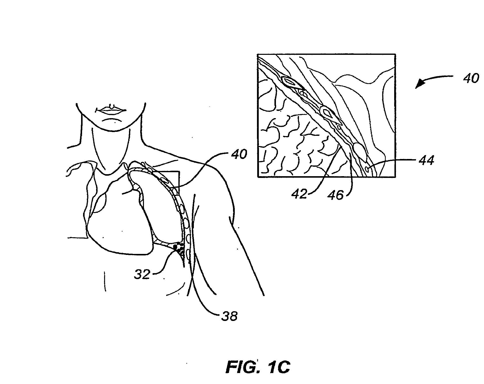 Minimally invasive lung volume reduction devices, methods, and systems