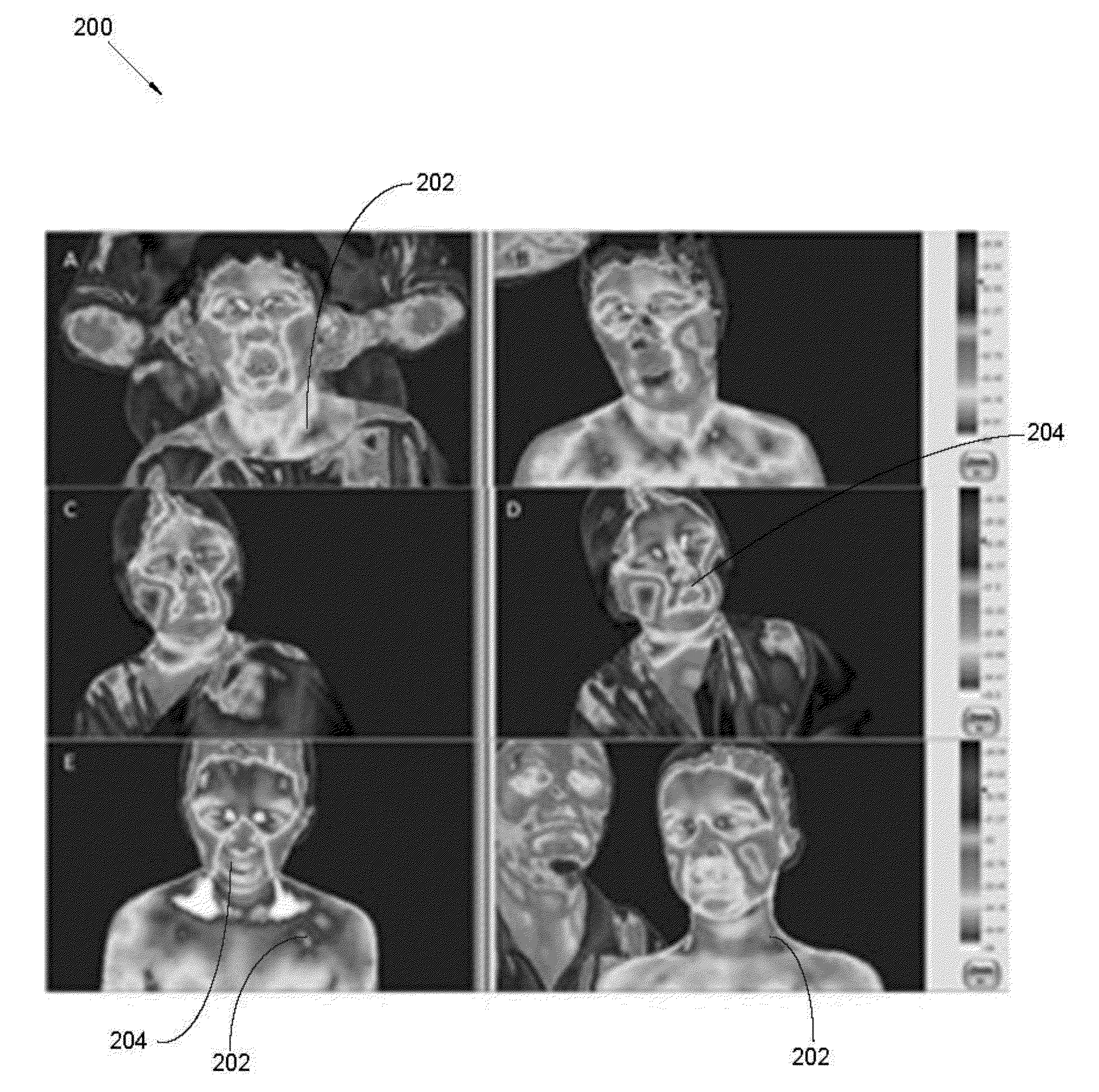 Method for detection treatment and prevention of neurological development disorders