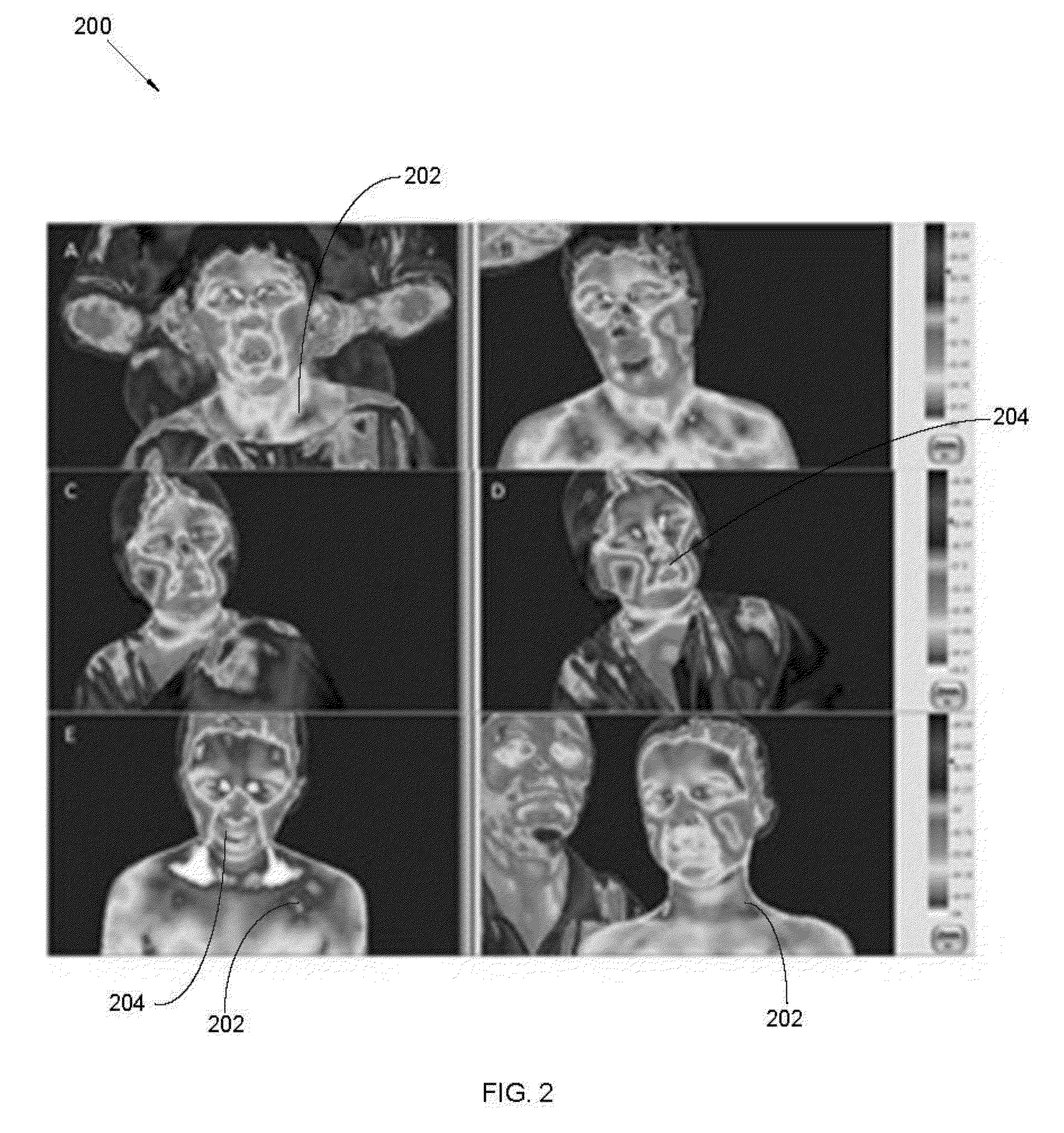 Method for detection treatment and prevention of neurological development disorders