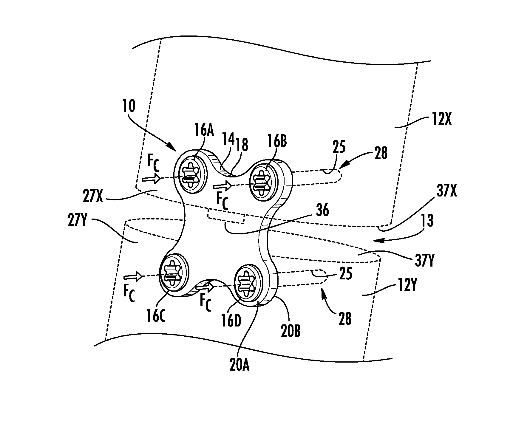 Anterior Cervical Plates For Spinal Surgery Employing Anchor Blackout Prevention Devices, And Related Systems And Methods