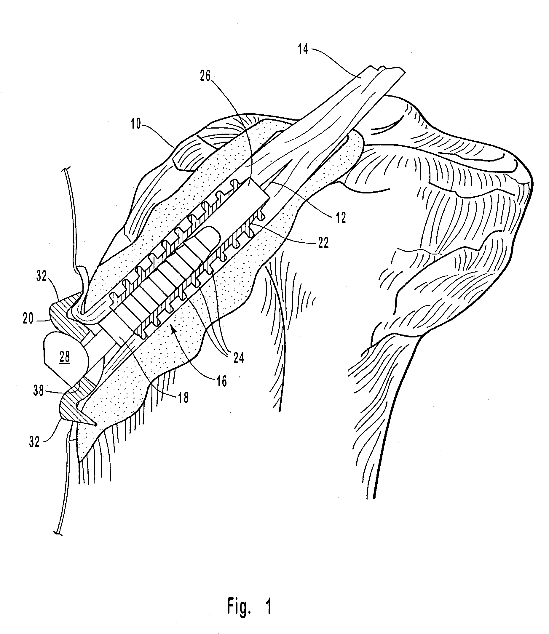 Securing connective tissue to a bone surface